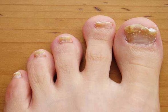 The appearance of toenails affected by fungus