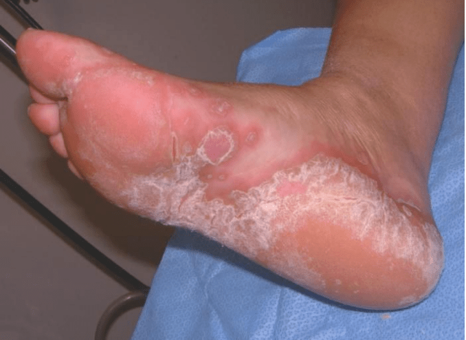 Determine the foot fungus