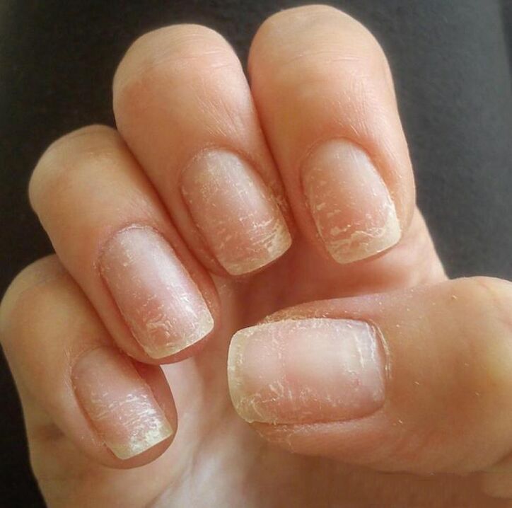 Fungal treatment and prevention