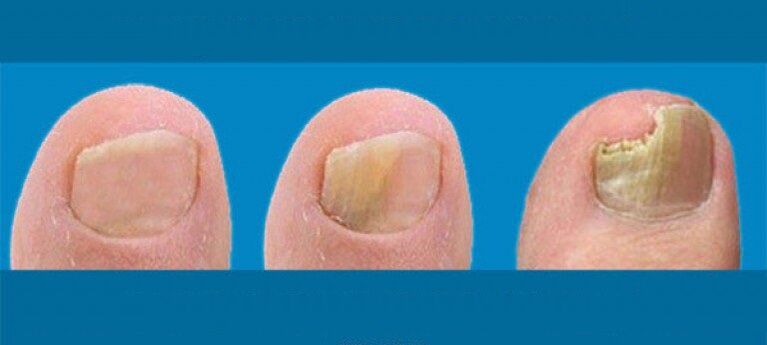 The process of nail fungus development