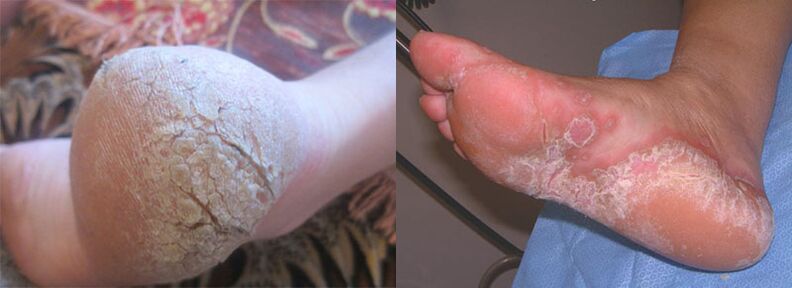 Feet affected by fungus