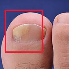 Mycosis or nails fungus