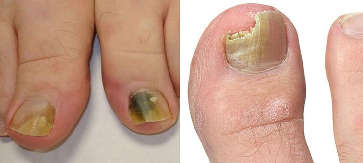 Onychomycosis - the destruction of nails with fungus