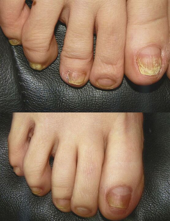 The use of boric acid to treat fungus