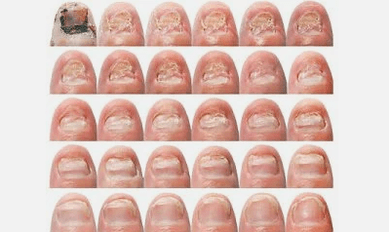 Like what nail fungus