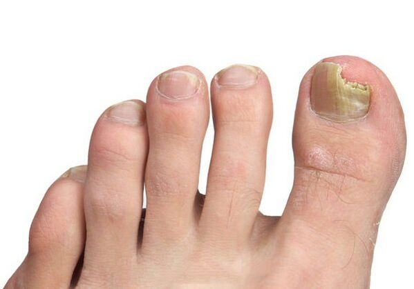 How is an infection with a fungus