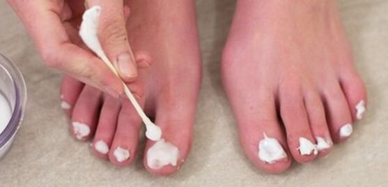 Treatment of toenail fungus with ointment