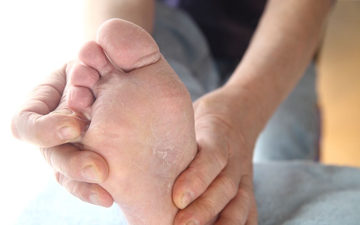 peeling skin with fungus on the feet