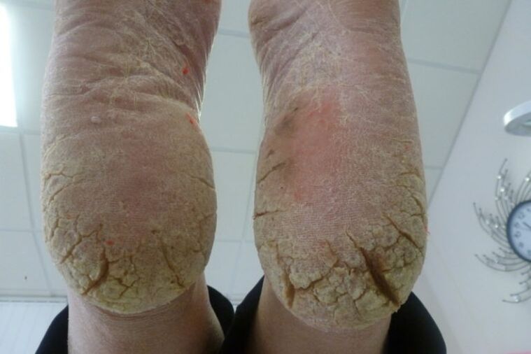 Deep cracks in the skin of the feet with an advanced form of fungus
