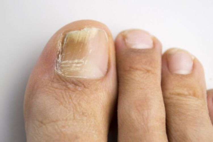 Fungal infection in toenails