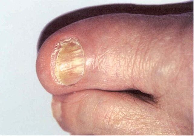 Onychomycosis - infection of the toenail by a fungus