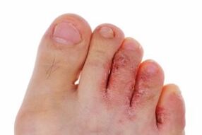fungal infection of the toes