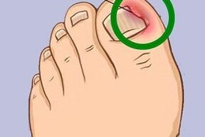 ingrown toenails due to nail fungus