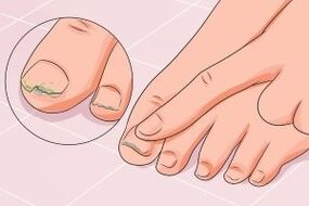 nail fungus infection