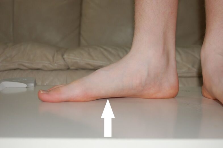 flat feet because