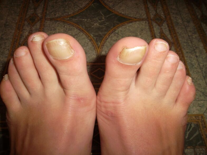 fungus on the thumb