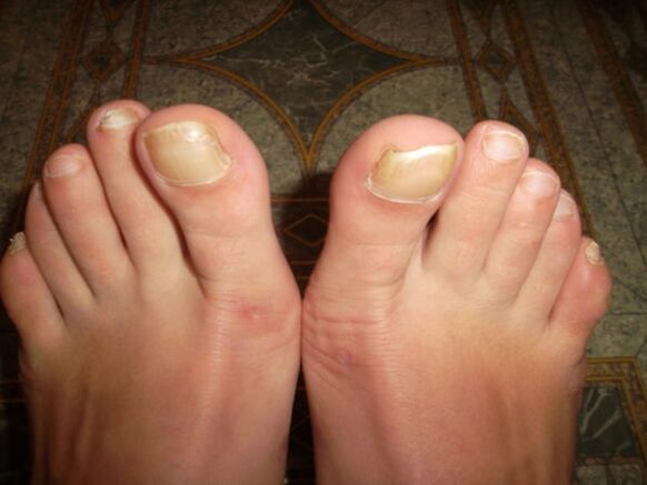 Fungal infection of the toenail