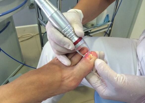 Laser treatment for toenail fungus